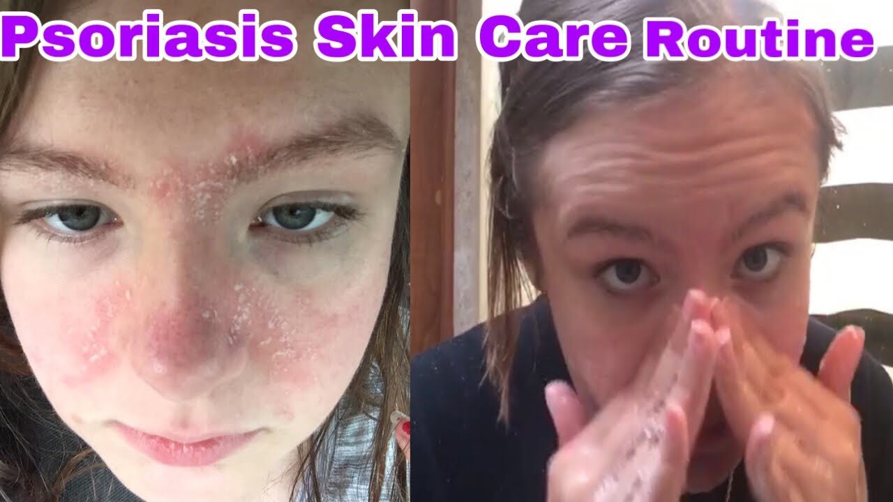 Psoriasis Skin Care Routine 2020