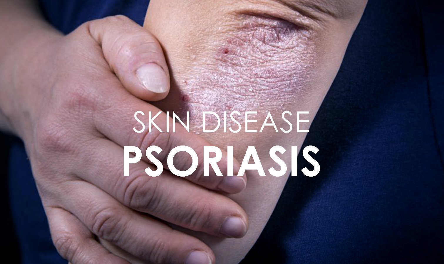 Psoriasis Skin Disease: Causes, Symptoms &  Treatments ...