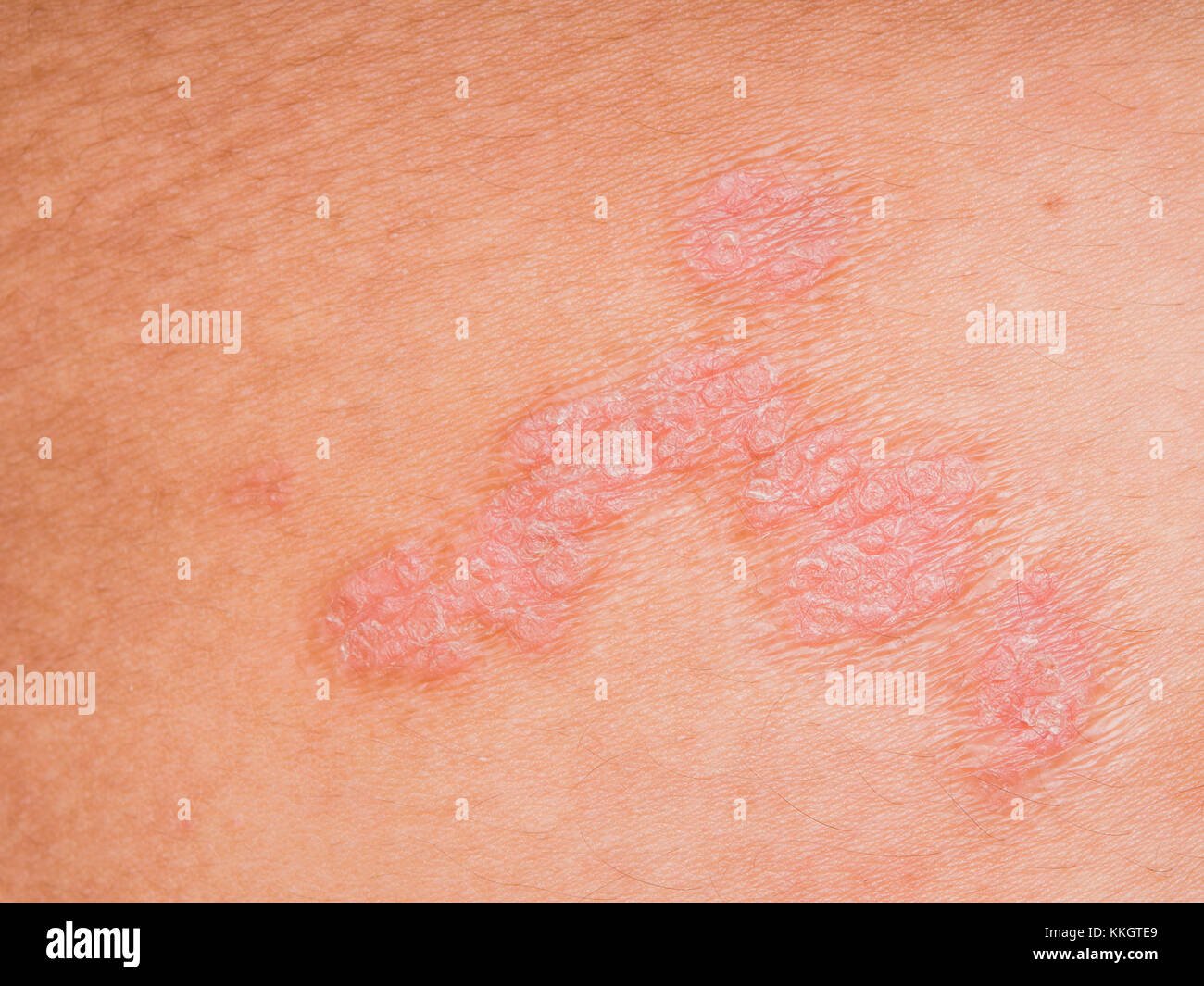 Psoriasis skin. Psoriasis is an autoimmune disease that affects the ...