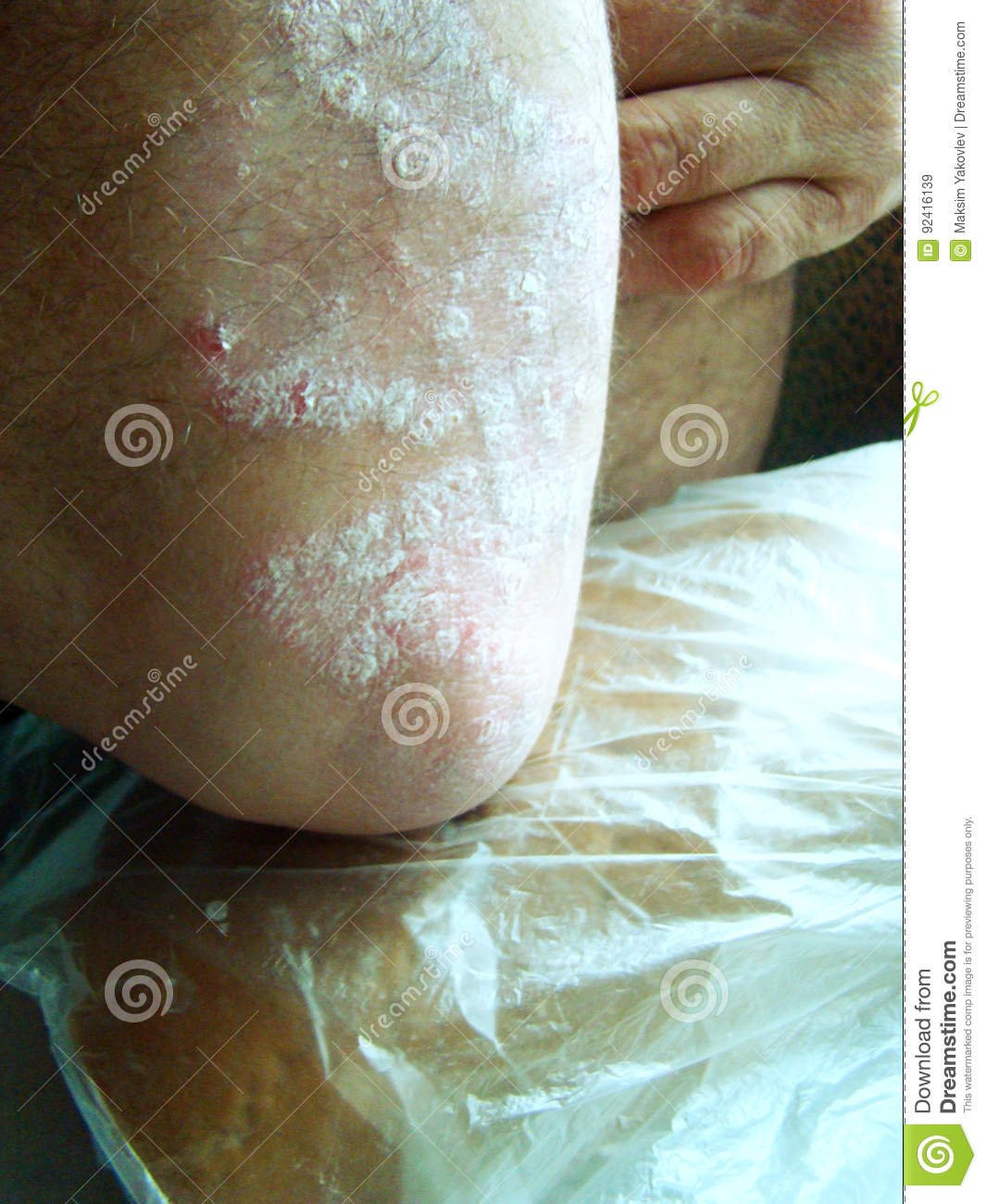 Psoriasis stock image. Image of disease, skin, treatment ...