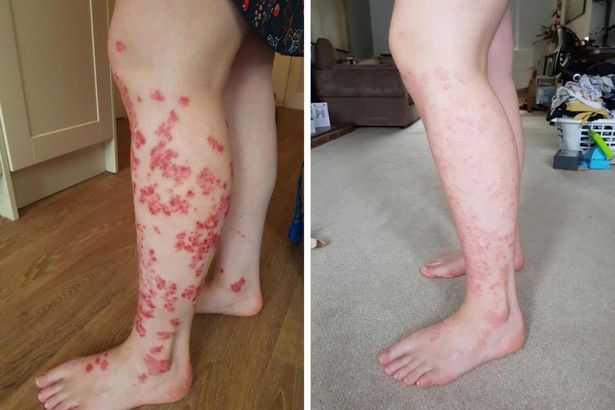 Psoriasis sufferer praises this £7 cream for finally clearing flare