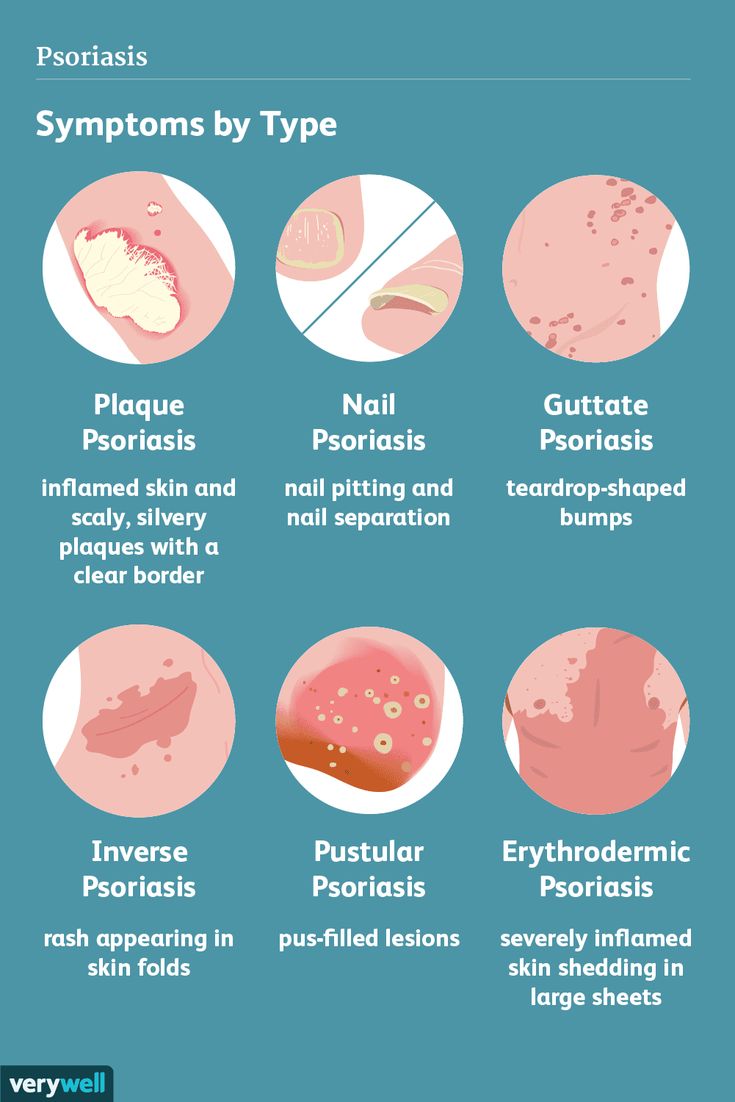 Psoriasis: Symptoms and Complications