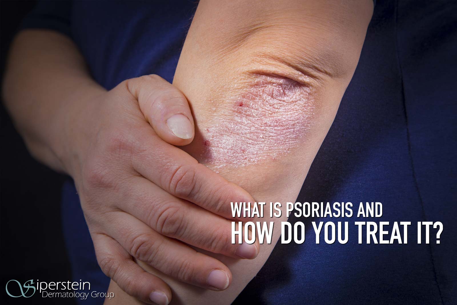 Psoriasis Symptoms And The Best Guide To Treating Them