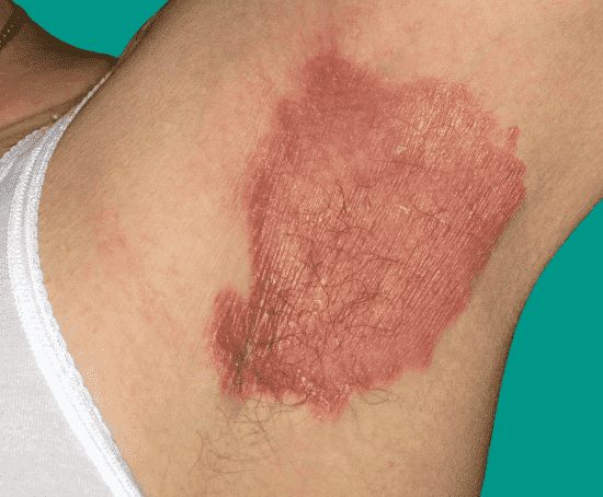Psoriasis: Symptoms, Causes, Types, and Treatments
