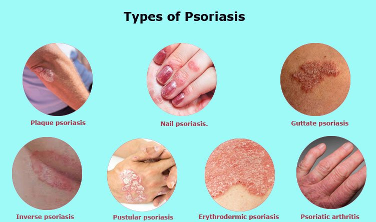 Psoriasis: Symptoms, Treatment and Preventions of flare