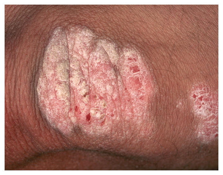 Psoriasis Symptoms: What Does Psoriasis Look Like?