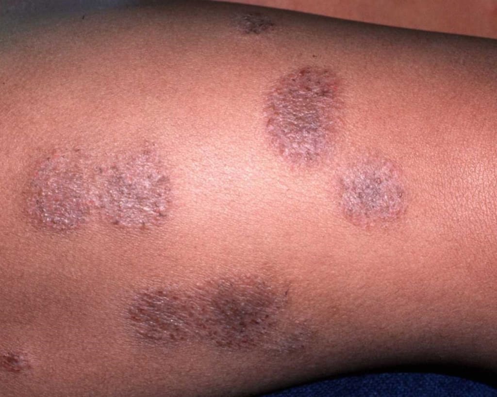 Psoriasis: The Silent Skin Disease