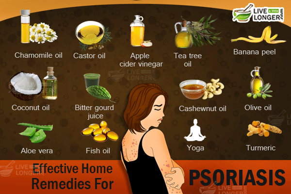 Psoriasis Treatment: Simple Natural Home Remedies To ...