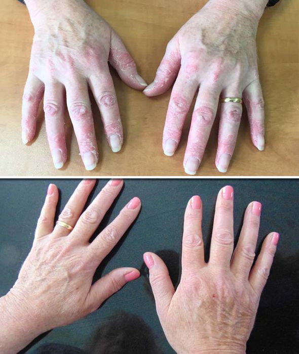 Psoriasis treatment update: Woman discovers miracle cure ...