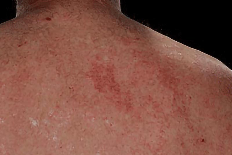 Psoriasis Treatments in London
