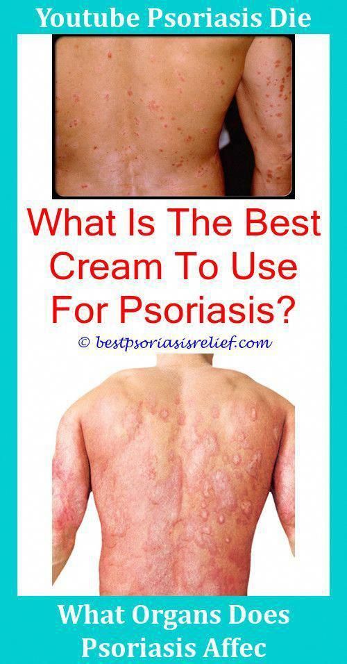 Psoriasis Treatments Over The Counter #PsoriasisTreatmentTamil id ...