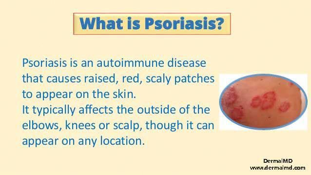 Psoriasis type I and type II are distinguished by a ...