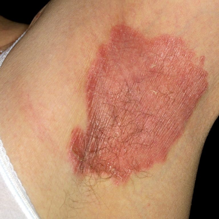 Psoriasis: Types, Symptoms, Causes, and Treatments.