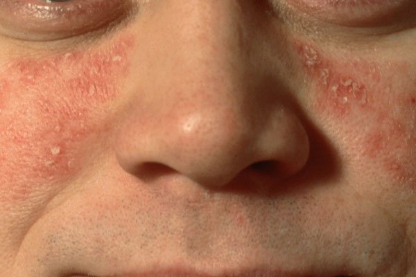 Psoriasis Variants &  Related Conditions
