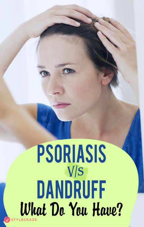Psoriasis Vs Dandruff: What Do You Have?