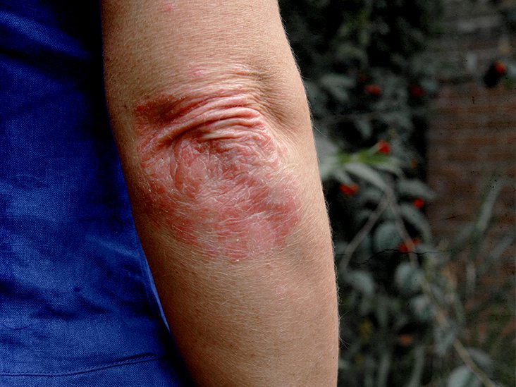 Psoriasis vs. eczema: Differences in symptoms and treatments
