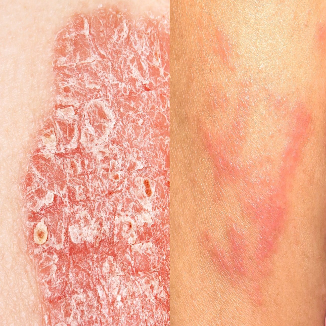Psoriasis Vs Eczema