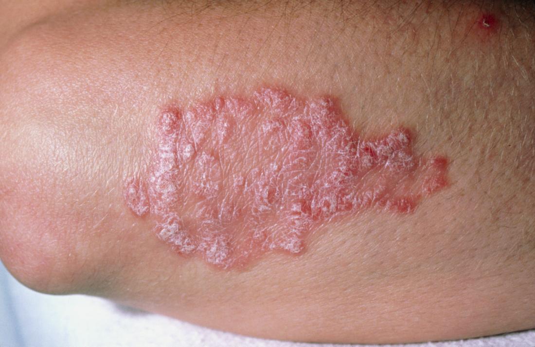 Psoriasis vs. lupus: Similarities and differences