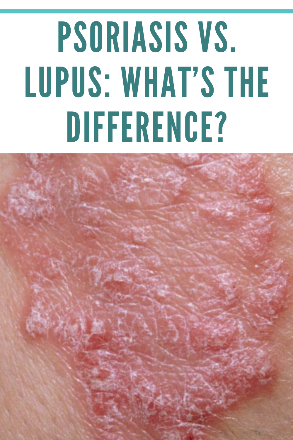 Psoriasis vs. Lupus: What