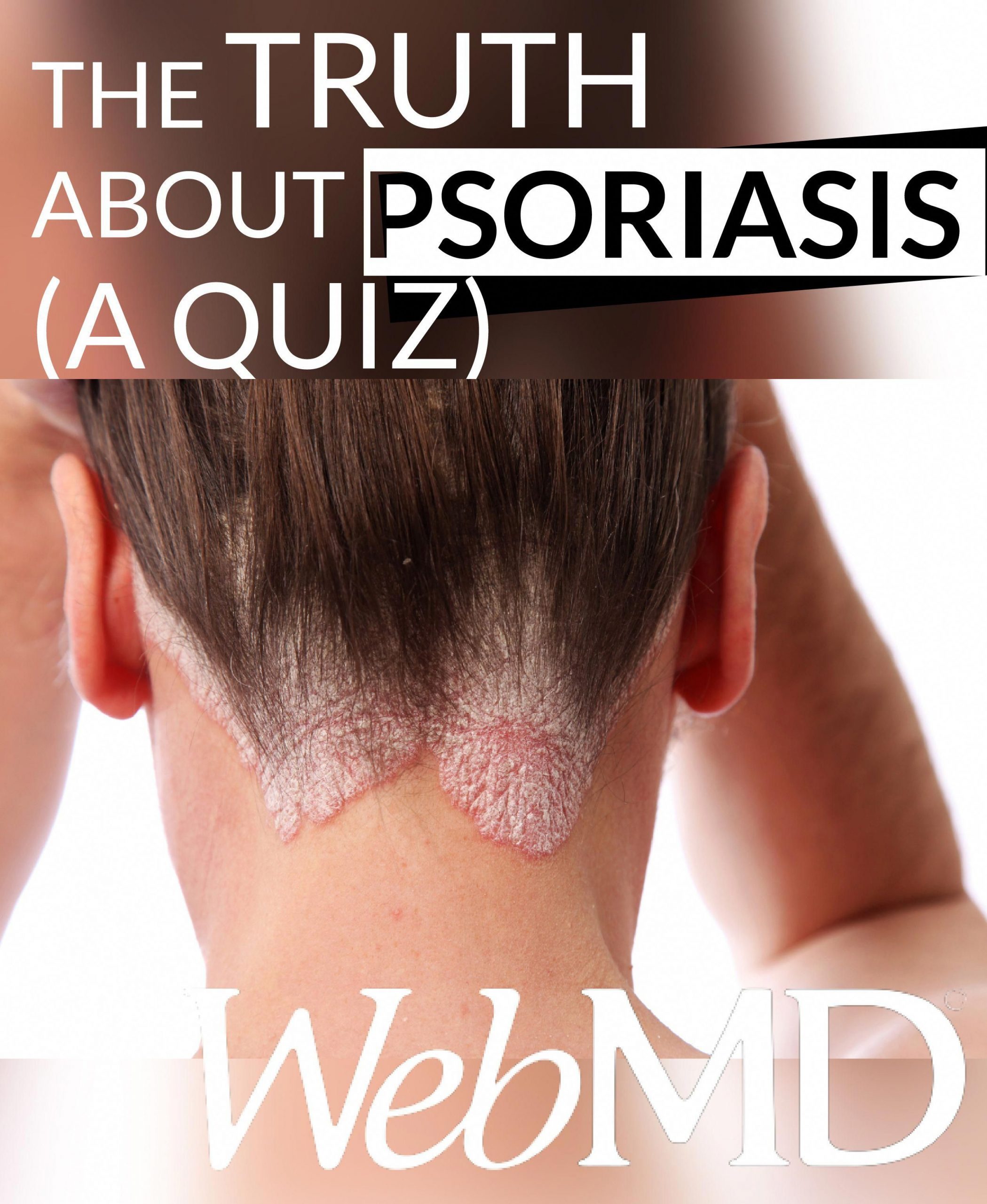 #psoriasis What do you know about psoriasis? Is it ...