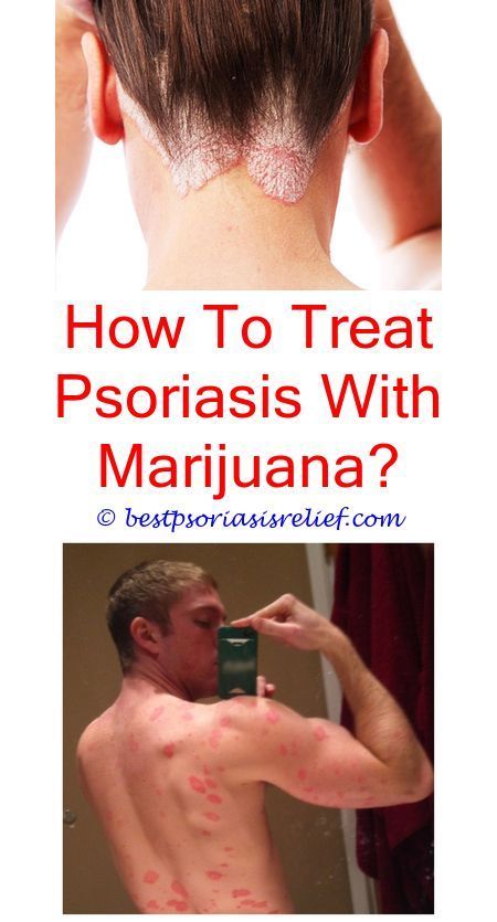 psoriasis what is the best way to treat psoriasis
