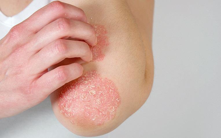 Psoriasis: What Triggers Flare