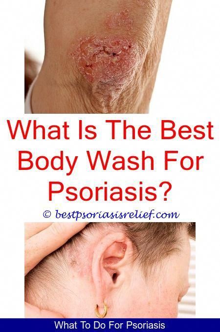 psoriasiscure home remedies for scalp psoriasis scales