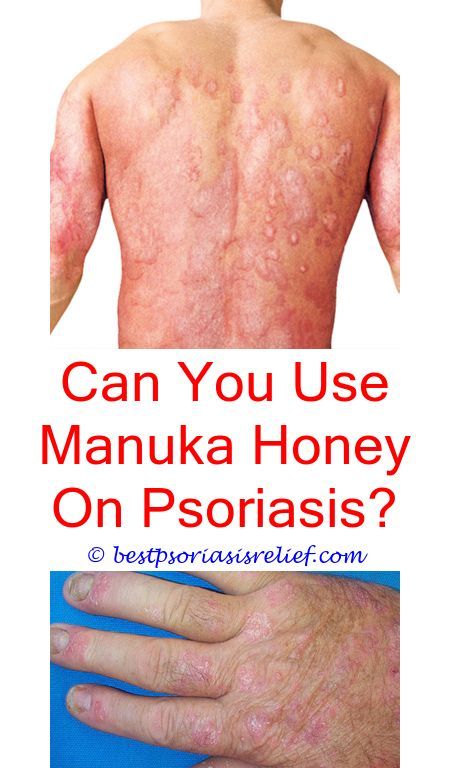 #psoriasisdiet can toddlers have psoriasis