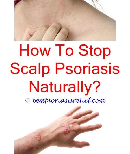psoriasismedication how to beat psoriasis naturally
