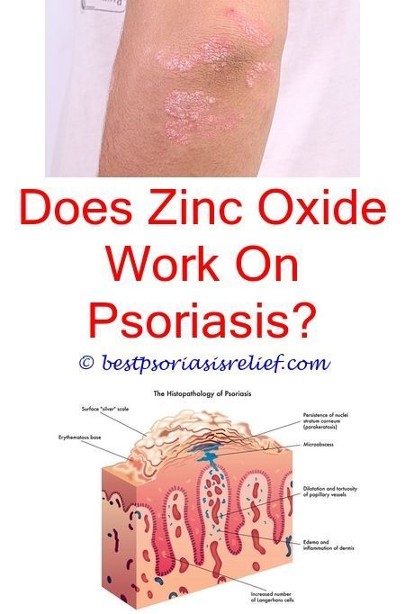psoriasisoftheliver denorex psoriasis reviews