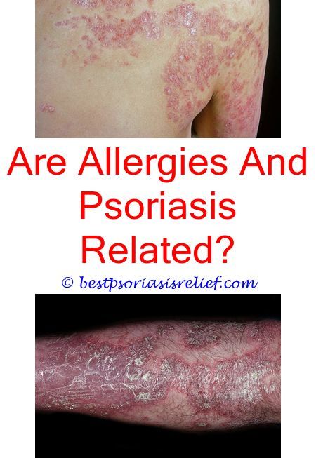 psoriasisonarms how to prevent psoriasis on face