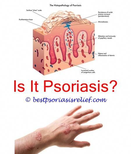 psoriasisonlegs what