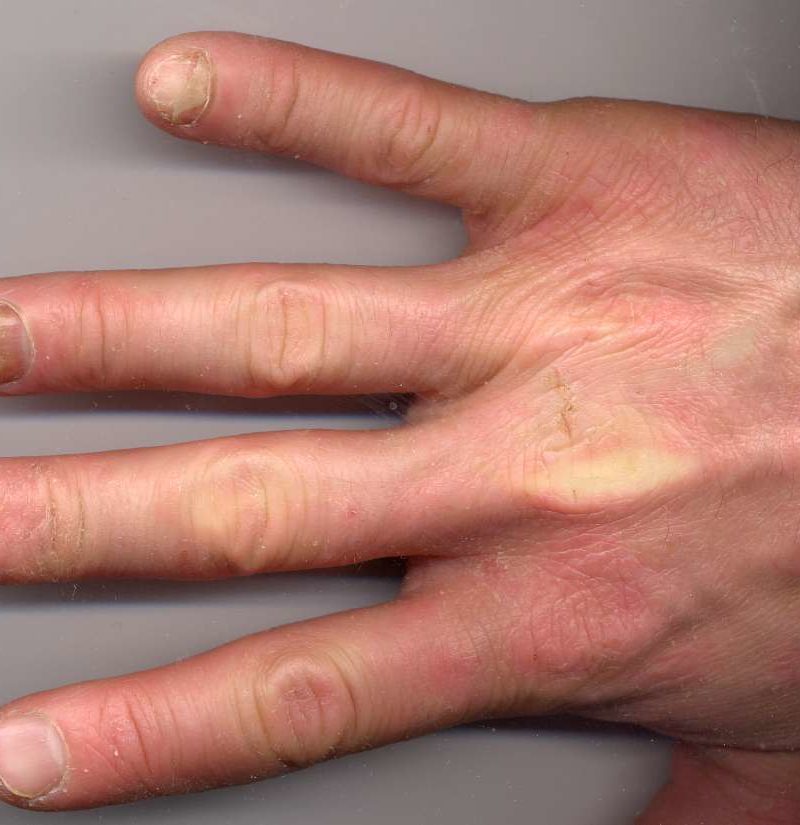 Psoriatic arthritis and nails: Changes, pictures, and ...