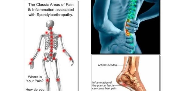 Psoriatic Arthritis Back Pain