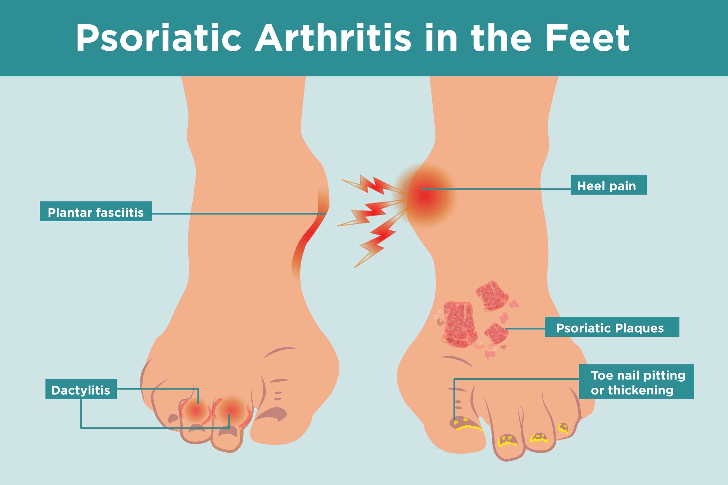 Psoriatic Arthritis in the Feet: Symptoms, Treatment, Home ...