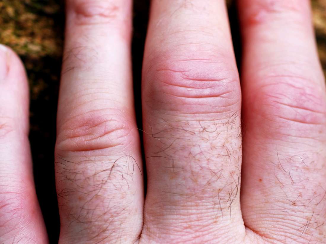 Psoriatic arthritis in the hands: Symptoms, pictures, and ...