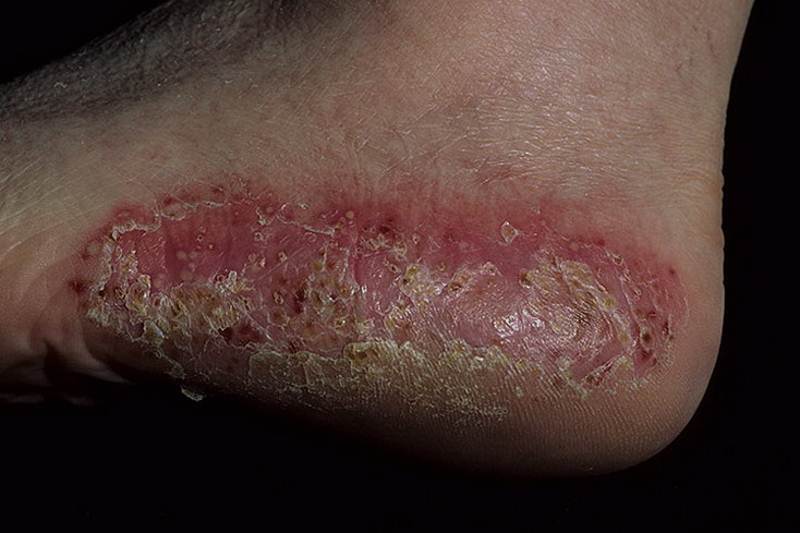 Pustular psoriasis on feet pictures