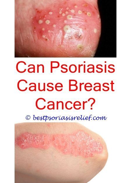 pustularpsoriasis how to get rid of psoriasis on scalp ...