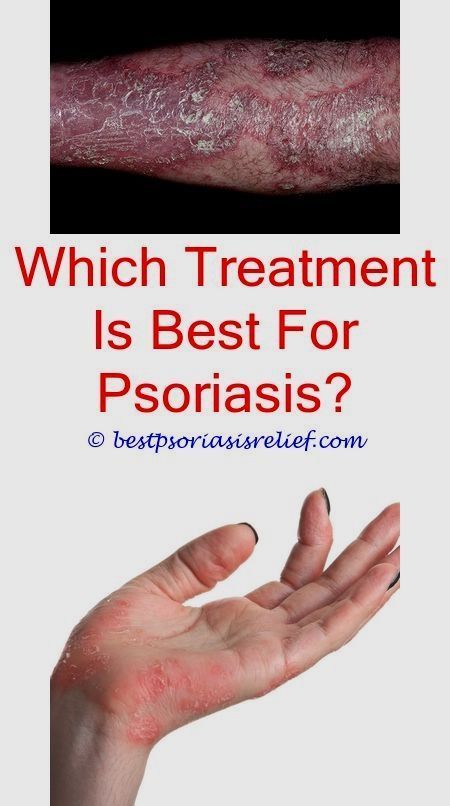 queeslapsoriasis psoriasis side effects mg217 psoriasis ...