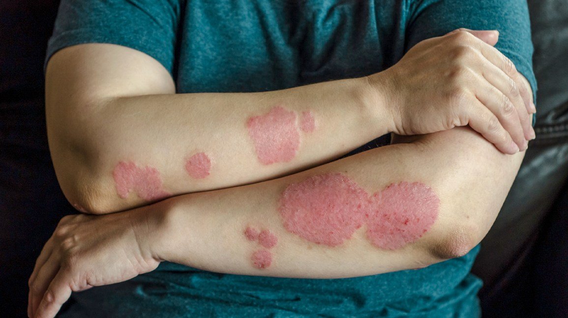 Reasons Why Your Psoriasis Treatment Isn