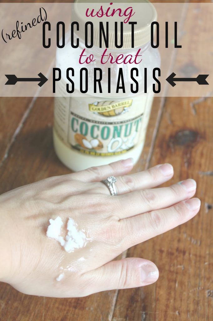 Refined Coconut Oil to Treat Psoriasis?