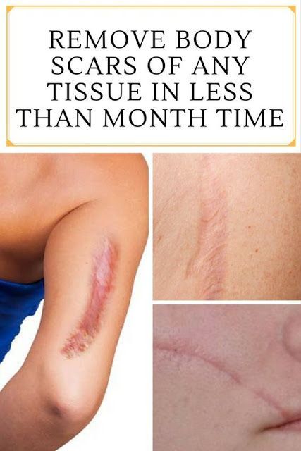 REMOVE BODY SCARS OF ANY TISSUE IN LESS THAN MONTH TIME ...