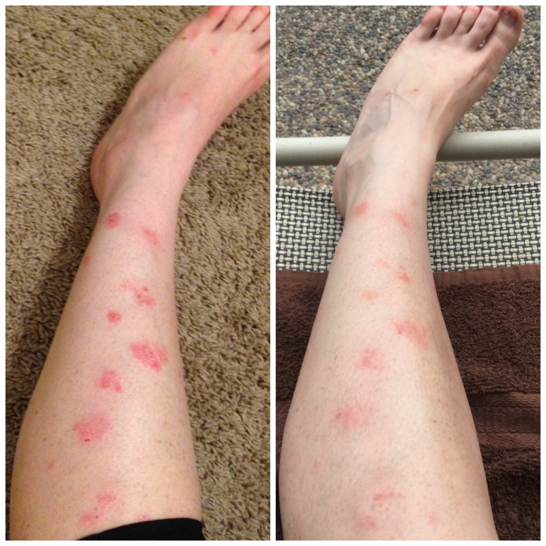 Results after one week on Humira : Psoriasis