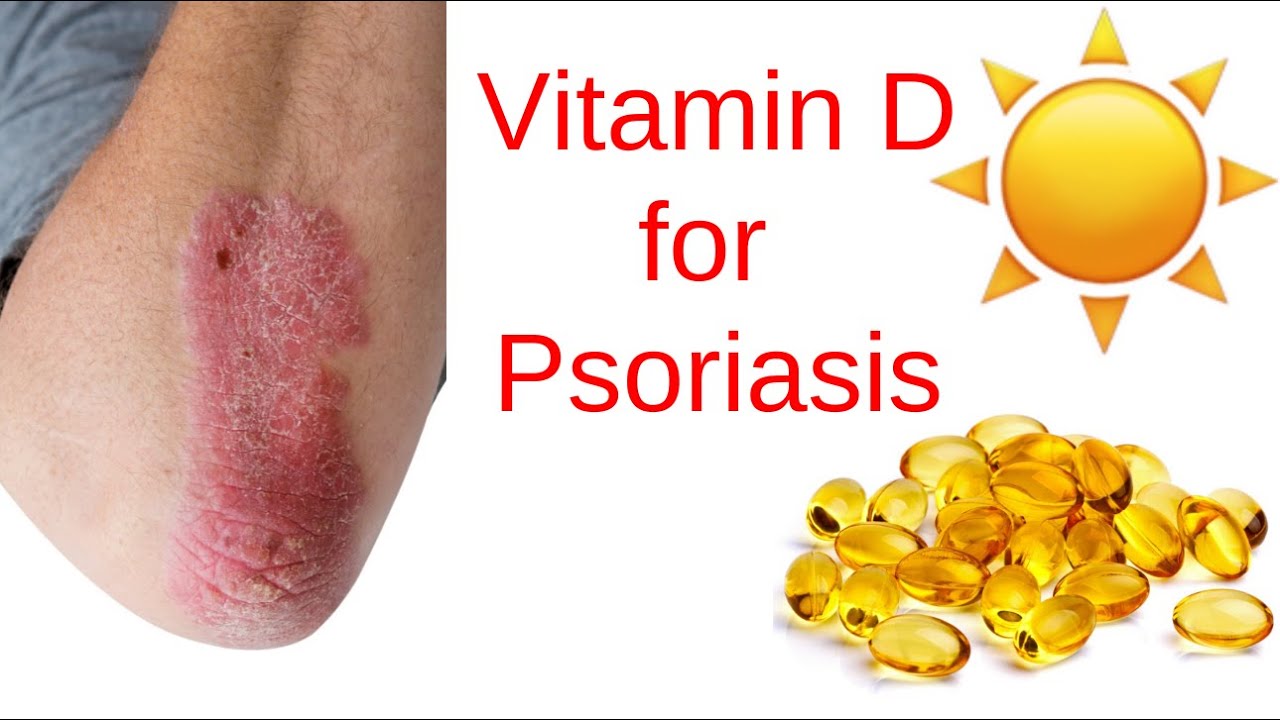Role of Vitamin D in Psoriasis healing