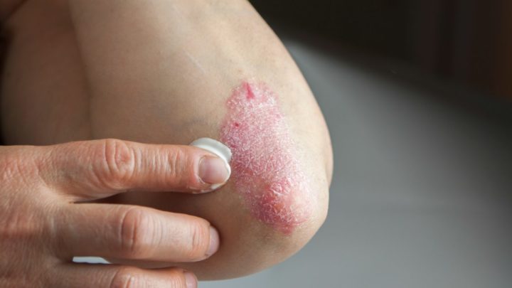 Say goodbye to itchy, scaly skin with these psoriasis ...