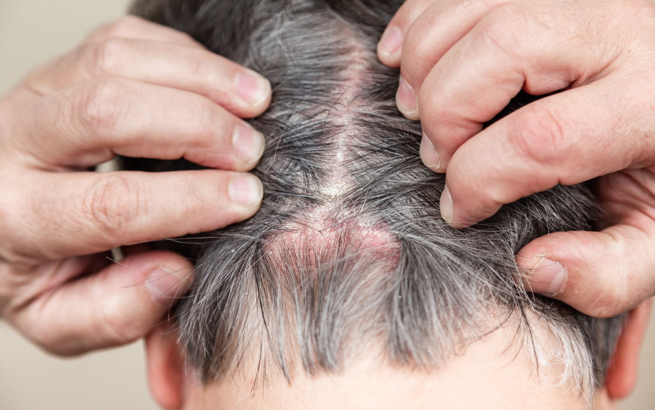 Scabs on Scalp: Causes, Diagnosis, and Treatment