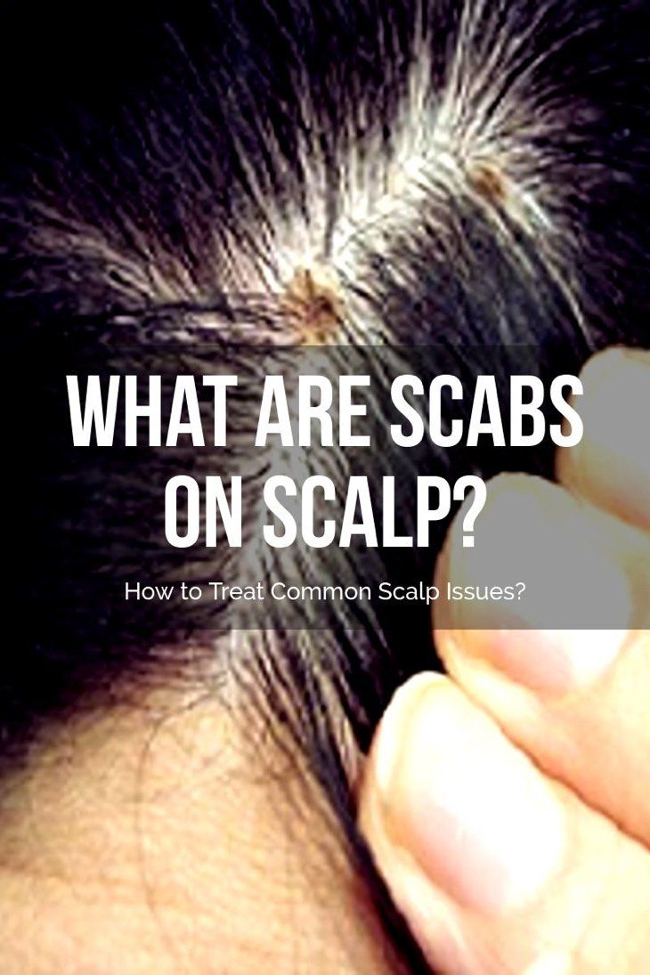 Scabs on scalp
