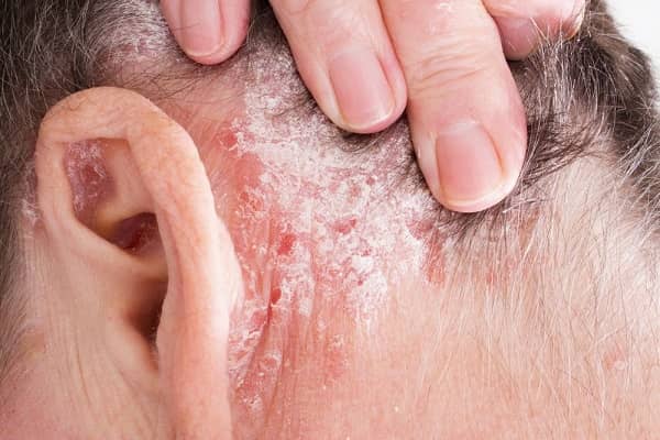 Scalp and Behind Ear Psoriasis [Removing Psoriasis from Ears ]