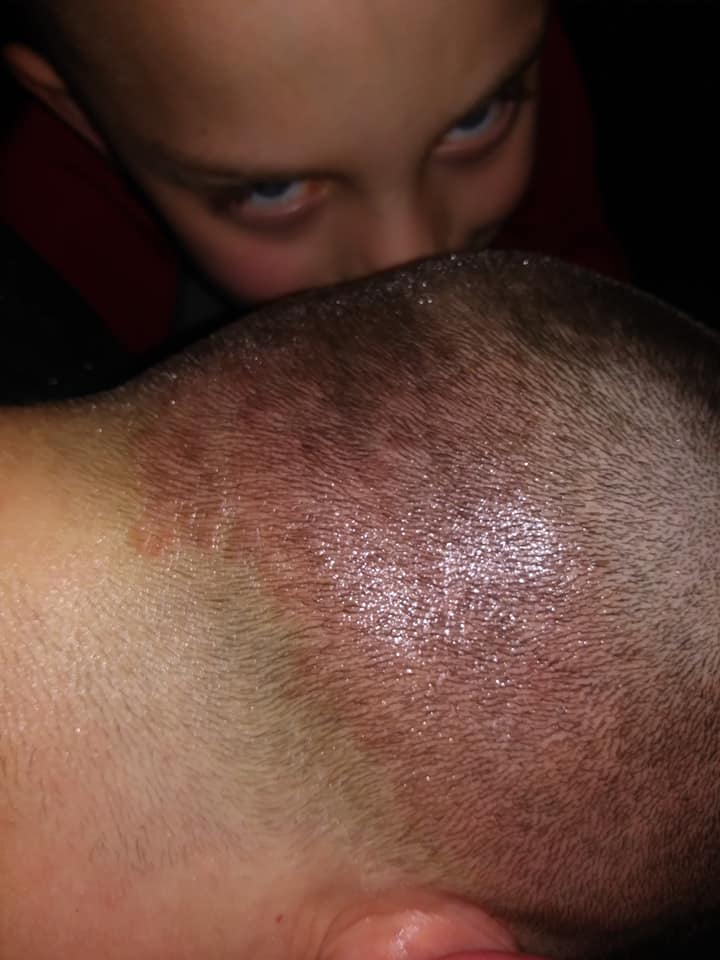 Scalp Psoriasis And Shaving (PICTURES And Story)
