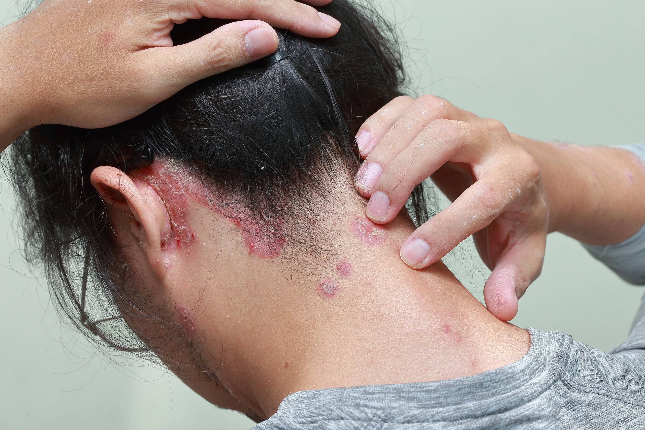 scalp psoriasis back of neck and ear